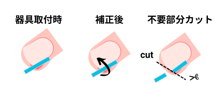 上から見た図_巻き爪の施術方法（ペディグラステクノロジー​）