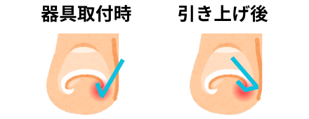 正面から見た図_巻き爪の施術方法（ペディグラステクノロジー​）