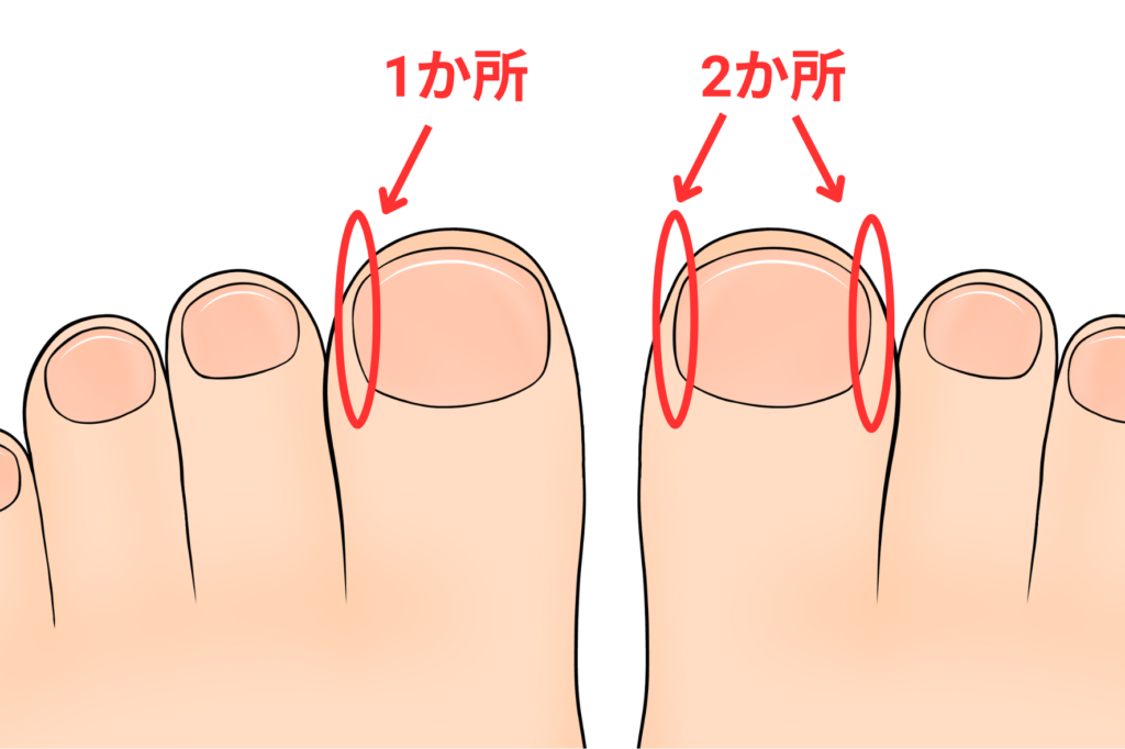 巻き爪_料金