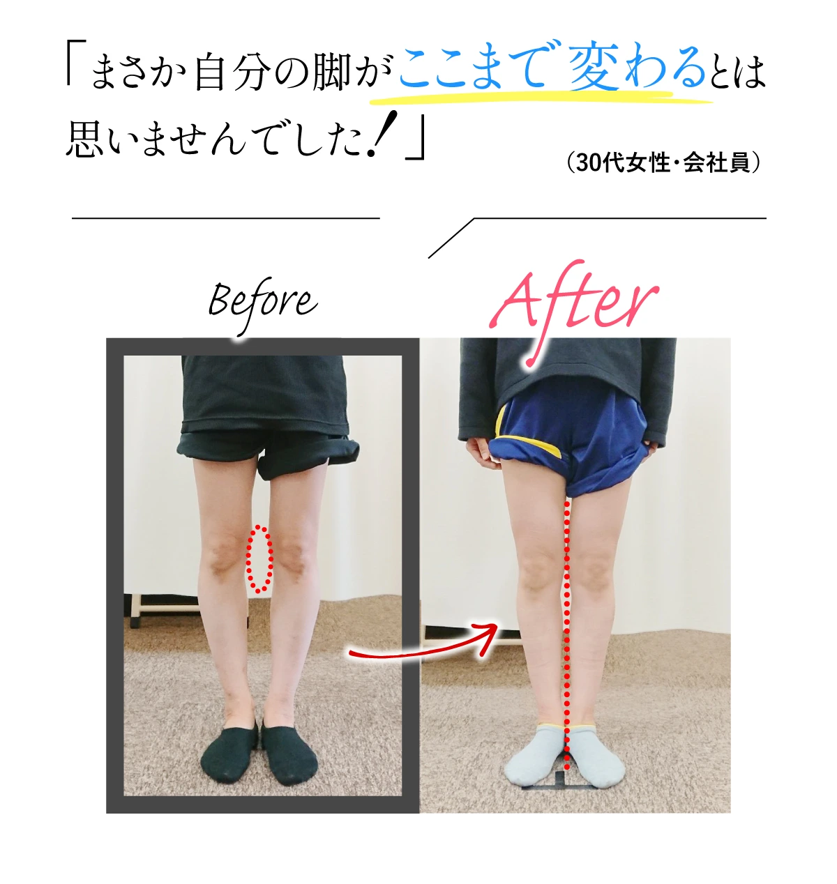ビフォーアフター「まさか自分の足がここまで変わるとは思いませんでした！」